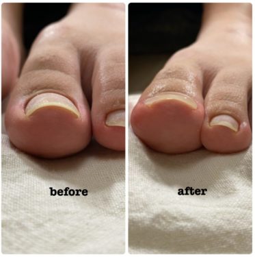 06-2　巻爪矯正　育成前・結果